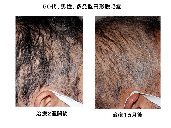 治療で傷んだ毛が抜けても、白髪は抜けない！なぜ、白髪は抜けにくい